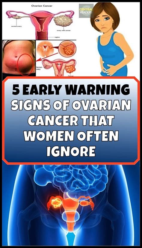 Ovarian cyst symptoms Most ovarian cysts are small. . My first symptoms of ovarian cancer reddit